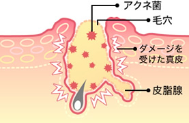 ニキビ跡の原因と仕組み_3