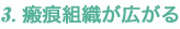 3.瘢痕組織が広がる