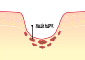 ニキビ跡の原因と仕組み_5