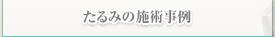 たるみの施術例