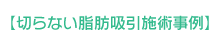 切らない脂肪吸引施術事例