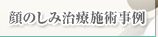 顔のしみ治療施術事例