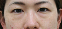 目の下のたるみ・くま 施術事例