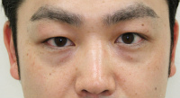目の下のたるみ・くま 施術事例