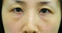 目の下のたるみ・くま 施術事例