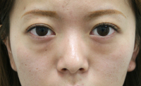 目の下のたるみ・くま 施術事例