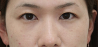 目の下のたるみ・くま 施術事例