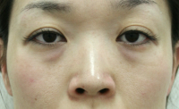 目の下のたるみ・くま 施術事例