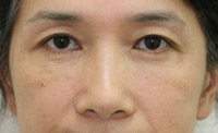 目の下のたるみ・くま 施術事例