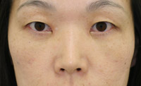 目の下のたるみ・くま 施術事例