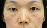 目の下のたるみ・くま 施術事例