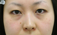 目の下のたるみ・くま 施術事例