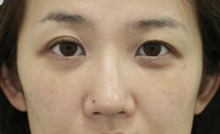 目の下のたるみ・くま 施術事例