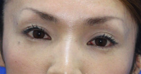 目の下のたるみ・くま 施術事例