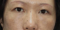 目の下のたるみ・くま 施術事例