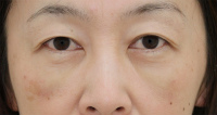 目の下のたるみ・くま 施術事例