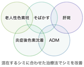 混在するシミに合わせた治療法でシミを改善