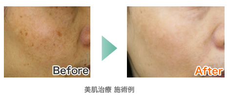 美肌治療 施術例