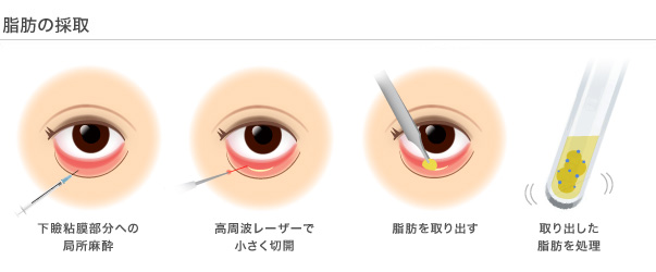 脂肪の採取