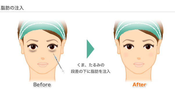 脂肪の注入