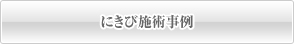 にきび施術事例