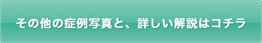 その他の症例写真と、詳しい解説はコチラ