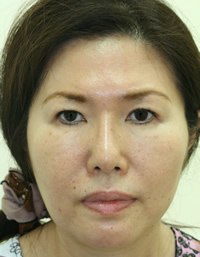 たるみ・しわ 施術事例