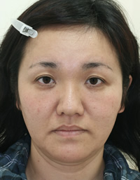 たるみ・しわ 施術事例