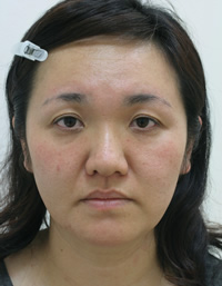 たるみ・しわ 施術事例