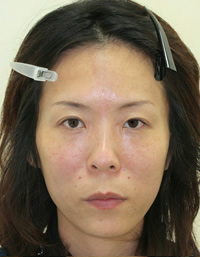 たるみ・しわ 施術事例