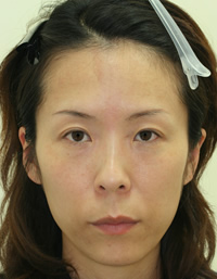 たるみ・しわ 施術事例