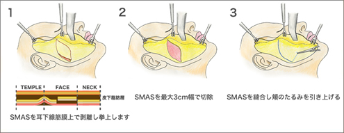 チークリフト