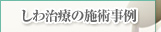 しわ治療の施術事例