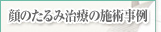 顔のたるみ治療の施術事例