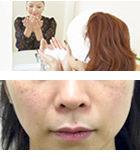 頬のたるみ