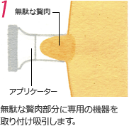 無駄な贅肉部分に専用の機器を取り付け吸引します。