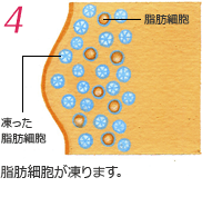 脂肪細胞が凍ります。