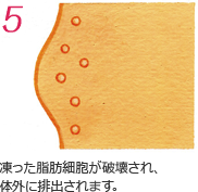 凍った脂肪細胞が破壊され、体外に排出されます。
