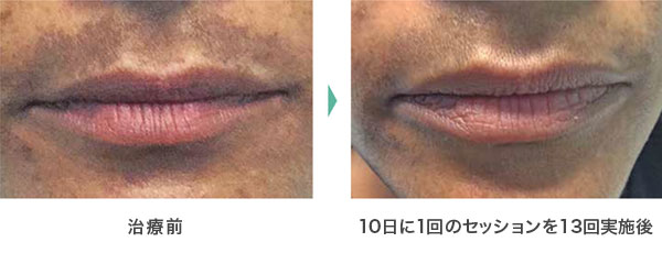 治療事例1
