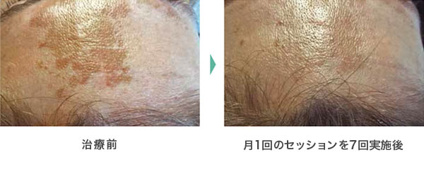 治療事例4