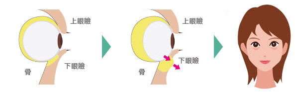 目の下の脂肪の移動によるくま・たるみができる流れ