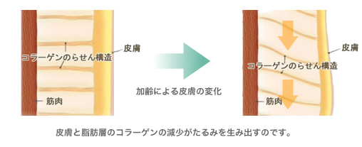 皮膚と脂肪層のコラーゲンの減少がたるみを生み出すのです
