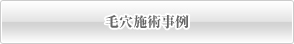 毛穴施術事例