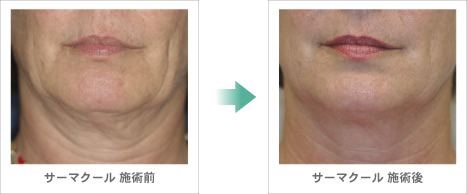 サーマクール症例写真（2）