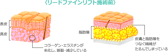 リードファインリフト施術前コラーゲン・エラスチンが劣化し、断裂・減少している皮膚と脂肪層をつなぐ繊維がたるんでしまっている