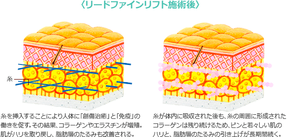 リードファインリフト施術後糸を挿入することにより人体に「創傷治癒」と「免疫」の働きを促す。その結果、コラーゲンやエラスチンが増殖。肌がハリを取り戻し、脂肪層のたるみも改善される。糸が体内に吸収された後も、糸の周囲に形成されたコラーゲンは残り続けるため、ピンと若々しい肌のハリと、脂肪層のたるみの引き上げが長期間続く。