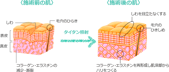施術前の肌施術後の肌