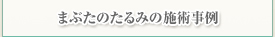 まぶたのたるみの施術事例