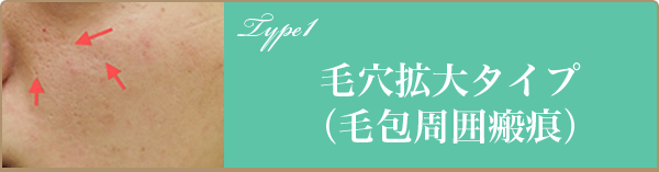 毛穴拡大タイプ（毛包周囲瘢痕）