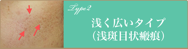 浅く広いタイプ（浅斑目状瘢痕）